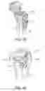 Fig. 32 - Methods and apparatus for performing knee arthroplasty