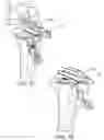 Fig. 41 - Methods and apparatus for performing knee arthroplasty