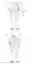 Fig. 49 - Methods and apparatus for performing knee arthroplasty