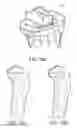 Fig. 60 - Methods and apparatus for performing knee arthroplasty
