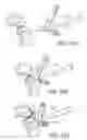 Fig. 64 - Methods and apparatus for performing knee arthroplasty