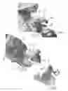 Fig. 05 - Tibia cutting assembly