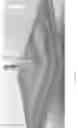 Fig. 125 - Pixel array medical systems, devices and methods