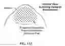 Fig. 129 - Pixel array medical systems, devices and methods