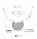 Fig. 131 - Pixel array medical systems, devices and methods