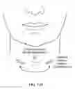 Fig. 136 - Pixel array medical systems, devices and methods
