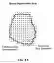 Fig. 139 - Pixel array medical systems, devices and methods