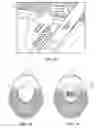 Fig. 40 - Pixel array medical systems, devices and methods