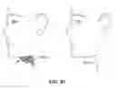 Fig. 85 - Pixel array medical systems, devices and methods