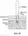 Fig. 87 - Pixel array medical systems, devices and methods