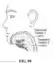 Fig. 90 - Pixel array medical systems, devices and methods