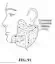 Fig. 91 - Pixel array medical systems, devices and methods