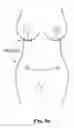 Fig. 96 - Pixel array medical systems, devices and methods