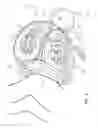 Fig. 04 - Nested needles for spinal cyst treatment