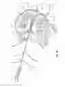 Fig. 05 - Nested needles for spinal cyst treatment