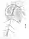 Fig. 10 - Nested needles for spinal cyst treatment
