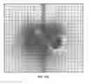 Fig. 28 - External adjustment device for distraction device