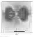 Fig. 35 - External adjustment device for distraction device