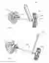 Fig. 05 - Fixation systems and methods of repairing a pars fracture