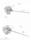 Fig. 08 - Fixation systems and methods of repairing a pars fracture