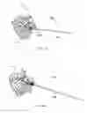 Fig. 17 - Fixation systems and methods of repairing a pars fracture