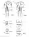 Fig. 03 - Expandable bone nail