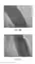 Fig. 48 - Tuned RF energy and electrical tissue characterization for selective treatment of target tissues
