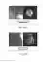 Fig. 63 - Tuned RF energy and electrical tissue characterization for selective treatment of target tissues