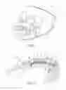 Fig. 03 - LINGUAL ORTHODONTIC APPLIANCE