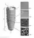 Fig. 01 - Dental implant