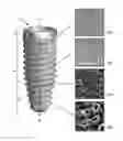 Fig. 02 - Dental implant