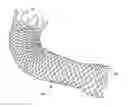 Fig. 01 - Exchange wire anchored by a self-expanding retrievable stent and method of use