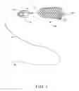 Fig. 02 - Exchange wire anchored by a self-expanding retrievable stent and method of use