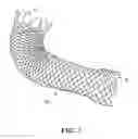 Fig. 04 - Exchange wire anchored by a self-expanding retrievable stent and method of use