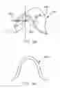 Fig. 07 - REFRACTIVE INTRAOCULAR IMPLANT LENS AND METHOD