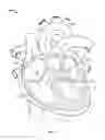 Fig. 02 - Mitral Valve Replacement Toggle Cell Securement