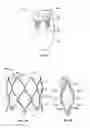 Fig. 03 - Mitral Valve Replacement Toggle Cell Securement