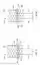 Fig. 11 - Mitral Valve Replacement Toggle Cell Securement