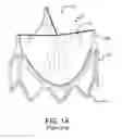 Fig. 02 - Prosthetic valve with improved washout