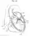 Fig. 11 - Dual-flange prosthetic valve frame