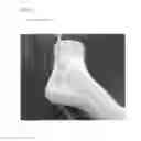 Fig. 16 - Cylindrical bandage