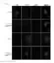 Fig. 44 - Methods of sensitizing tumor cells to weak base chemotherapeutic drugs