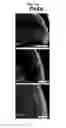 Fig. 05 - LENS REGENERATION USING ENDOGENOUS STEM/PROGENITOR CELLS