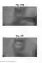 Fig. 22 - LENS REGENERATION USING ENDOGENOUS STEM/PROGENITOR CELLS