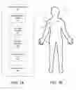 Fig. 02 - SUCTION COLLAR FOR ELECTROSURGICAL DEVICES