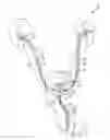 Fig. 01 - Ureteral and bladder catheters and methods of inducing negative pressure to increase renal perfusion
