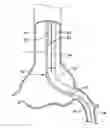 Fig. 01 - Trap balloon catheter with trap balloon retainer