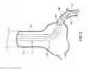 Fig. 03 - Trap balloon catheter with trap balloon retainer