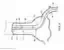 Fig. 04 - Trap balloon catheter with trap balloon retainer