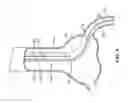 Fig. 05 - Trap balloon catheter with trap balloon retainer